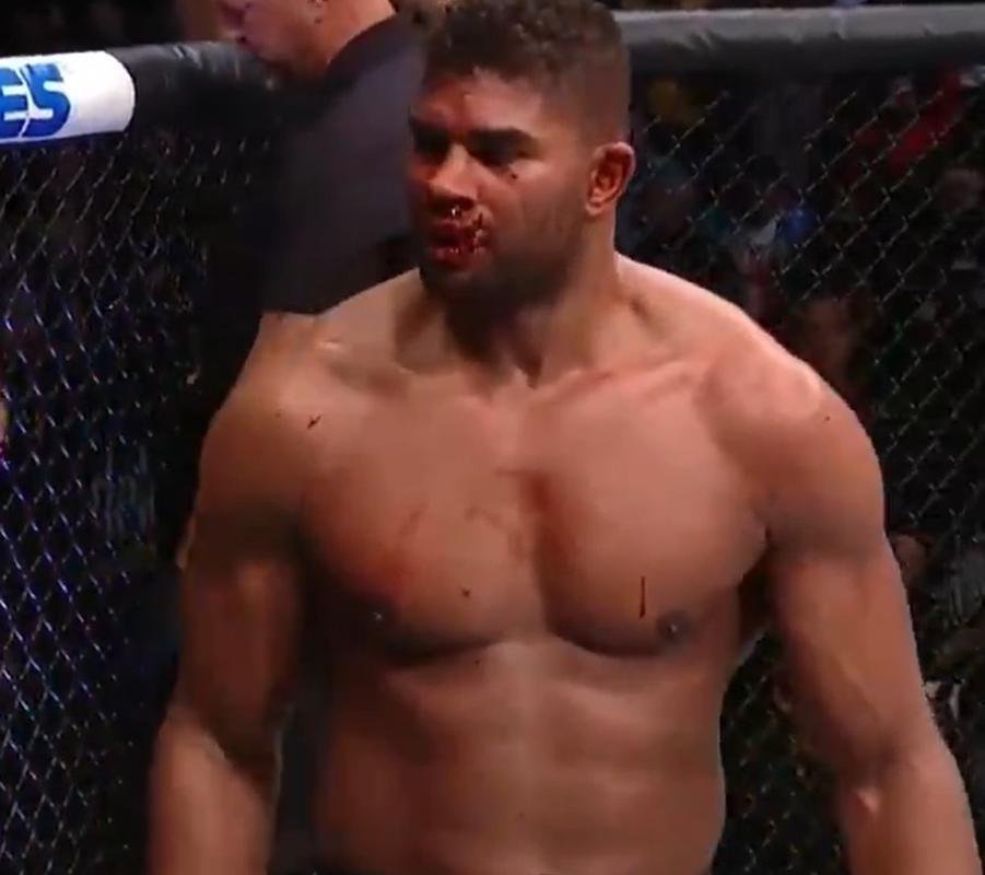 Alistair Overeem ficou com o lbio cortados aps a derrota por nocaute para Jairzinho Rozenstruik