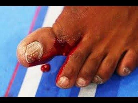 Jon Jones fraturou o dedo do p na vitria sobre Chael Sonnen, em 2013, no primeiro round. Se a luta fosse para o intervalo, o ento campeo dos meio-pesados teria sido perdido o cinturo por causa da leso, por nocaute tcnico