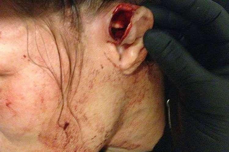 Leslie Smith sofreu um ferimento grave na orelha esquerda em derrota para Jessia Eye, em 2015