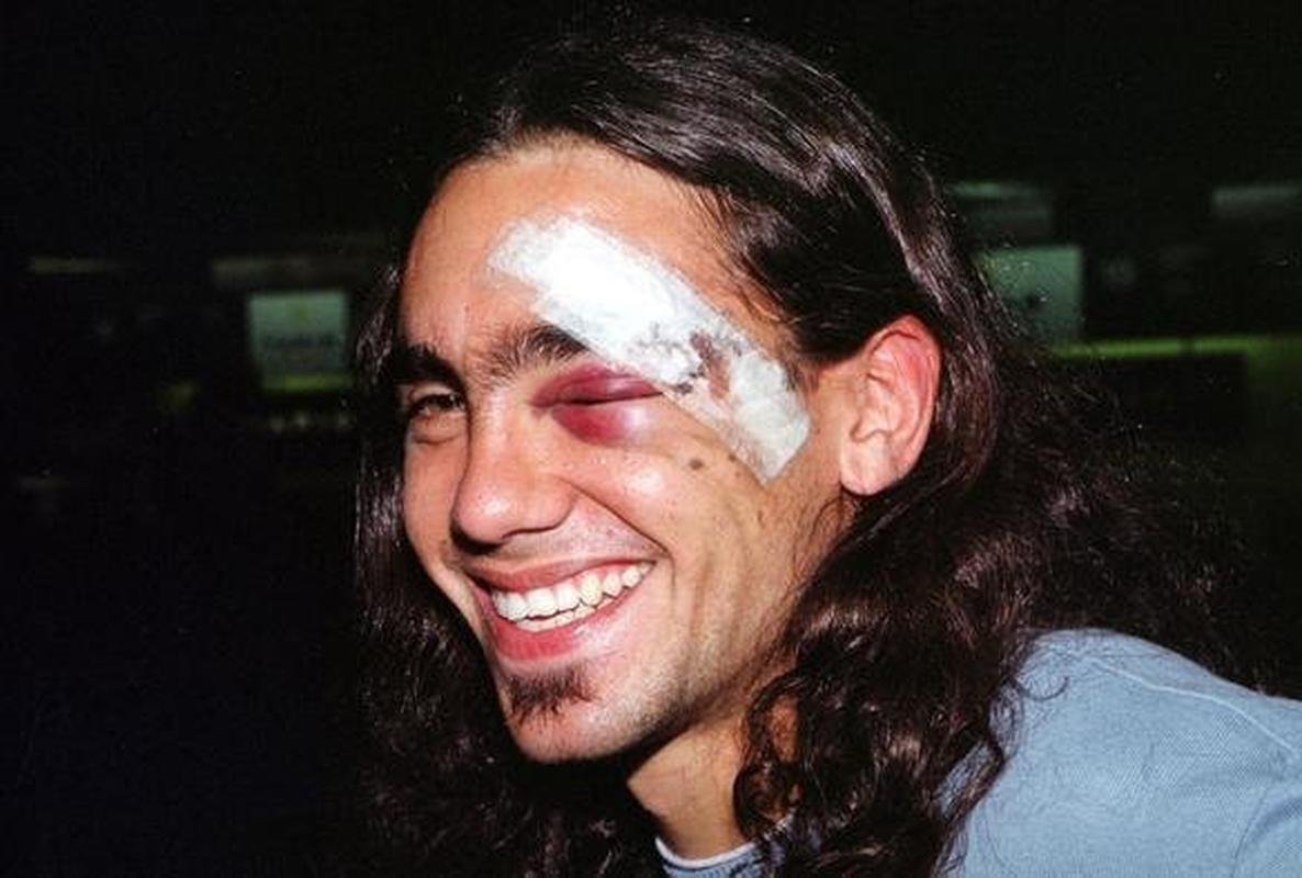 O dia aps a batalha: Sorn mostra os hematomas no superclio que no o impediram de continuar na partida