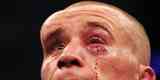 Matt Homenick ficou com enormes galos na testa e cortes nos olhos aps derrota para Jos Aldo, em 2011, valendo o cinturo do peso pena