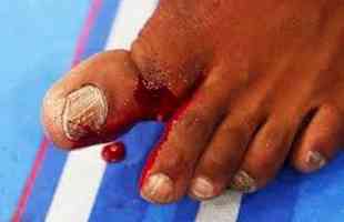 Jon Jones fraturou o dedão do pé na vitória sobre Chael Sonnen, em 2013, no primeiro round. Se a luta fosse para o intervalo, o então campeão dos meio-pesados teria sido perdido o cinturão por causa da lesão, por nocaute técnico