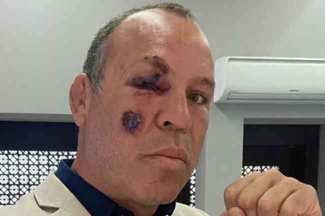 Wanderlei Silva exibe marcas no rosto aps outro acidente no trnsito