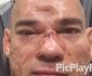 Brasileiro sofre afundamento no crnio aps ser nocauteado por 'novo Anderson Silva' no Bellator