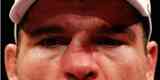 Mauricio Shogun ficou com nariz torto aps nocaute sofrido para Dan Henderson